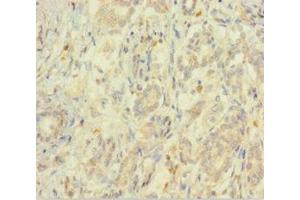 Immunohistochemistry of paraffin-embedded human pancreatic cancer using ABIN7152209 at dilution of 1:100 (EIF5 antibody  (AA 1-431))