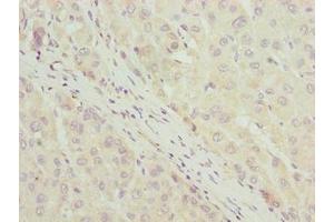 Immunohistochemistry of paraffin-embedded human liver cancer using ABIN7158480 at dilution of 1:100 (Uncharacterized Protein C7orf34 (LLCFC1) (AA 29-122) antibody)
