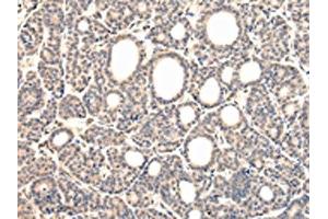 The image on the left is immunohistochemistry of paraffin-embedded Human thyroid cancer tissue using ABIN7131585(VPS37D Antibody) at dilution 1/30, on the right is treated with fusion protein. (VPS37D antibody)