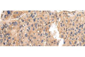 Immunohistochemistry of paraffin-embedded Human liver cancer using VAMP5 Polyclonal Antibody at dilution of 1/25 (VAMP5 antibody)