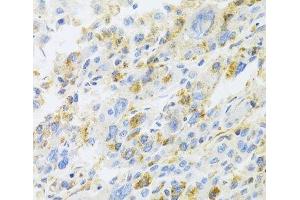 Immunohistochemistry of paraffin-embedded Human liver cancer using CXCR3 Polyclonal Antibody at dilution of 1:100 (40x lens). (CXCR3 antibody)