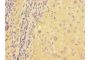 Immunohistochemistry of paraffin-embedded human liver cancer using ABIN7150136 at dilution of 1:100 (DDIT4L antibody  (AA 1-163))