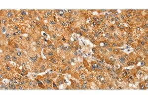 Immunohistochemistry of paraffin-embedded Human liver cancer using TRIM62 Polyclonal Antibody at dilution of 1:30 (TRIM62 antibody)