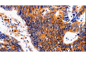 Immunohistochemistry of paraffin-embedded Human colon cancer tissue using IL18BP Polyclonal Antibody at dilution 1:50 (IL18BP antibody)
