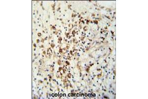 HAUS5 Antibody immunohistochemistry analysis in formalin fixed and paraffin embedded human colon carcinoma followed by peroxidase conjugation of the secondary antibody and DAB staining. (HAUS5 antibody  (N-Term))