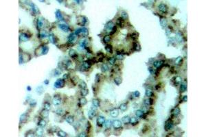 Immunohistochemistry of paraffin-embedded Human lung carcinoma tissue, using Phospho-PKCalpha/beta II(T638/641) Polyclonal Antibody (PRKCA beta 2 antibody  (pThr638, pThr641))