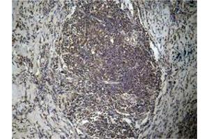 Immunohistochemical staining of human breast cancer tissue with HIST1H3D (Di-methyl-K27) polyclonal antibody  under 1:50-1:100 dilution. (HIST1H3D antibody  (2meLys27))