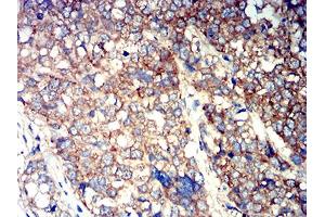 Immunohistochemical analysis of paraffin-embedded breast cancer tissues using ATG3 mouse mAb with DAB staining. (ATG3 antibody  (AA 1-100))
