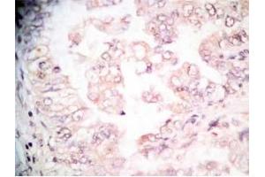 Human lung cancer tissue stained by Rabbit-Anti-GRP Pro (80-97) (H) Antibody (Gastrin-Releasing Peptide antibody  (AA 80-97))