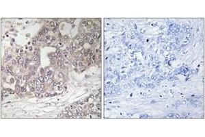 Immunohistochemistry analysis of paraffin-embedded human liver carcinoma tissue, using ATG4C Antibody. (ATG4C antibody  (AA 21-70))