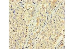 Immunohistochemistry of paraffin-embedded human lung cancer using ABIN7170528 at dilution of 1:100 (SPATS1 antibody  (AA 1-300))