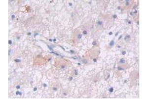 IHC-P analysis of Human Glioma Tissue, with DAB staining. (EGFR antibody  (AA 713-984))