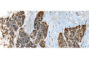 Immunohistochemistry of paraffin-embedded Human thyroid cancer tissue using CALML5 Polyclonal Antibody at dilution of 1:70(x200)