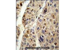 Formalin-fixed and paraffin-embedded human hepatocarcinoma reacted with SERPINC1 Antibody , which was peroxidase-conjugated to the secondary antibody, followed by DAB staining. (SERPINC1 antibody  (C-Term))