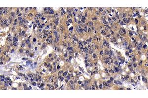 Detection of MIP3b in Human Lymphoma Tissue using Polyclonal Antibody to Macrophage Inflammatory Protein 3 Beta (MIP3b) (CCL19 antibody  (AA 22-98))