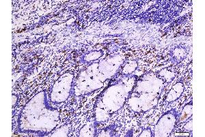 Formalin-fixed and paraffin embedded human colon cancer tissue labeled with Anti-Beta-Catenin (Ser33 + 37) Polyclonal Antibody, Unconjugated  at 1:200 followed by conjugation to the secondary antibody and DAB staining. (beta Catenin antibody  (pSer33, pSer37))
