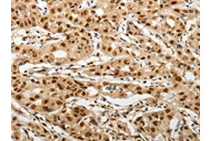 The image on the left is immunohistochemistry of paraffin-embedded Human lung cancer tissue using ABIN7192598(SOCS7 Antibody) at dilution 1/30, on the right is treated with synthetic peptide.