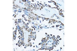 Immunohistochemistry of paraffin-embedded human thyroid cancer using O Rabbit pAb (ABIN6133230, ABIN6137338, ABIN6137339 and ABIN6224128) at dilution of 1:100 (40x lens). (ATP5O antibody  (AA 24-213))