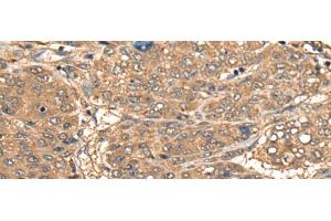 Immunohistochemistry of paraffin-embedded Human liver cancer tissue using CCL27 Polyclonal Antibody at dilution of 1:55(x200)
