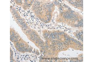 Immunohistochemistry of Human colon cancer using TLR4 Polyclonal Antibody at dilution of 1:40 (TLR4 antibody)