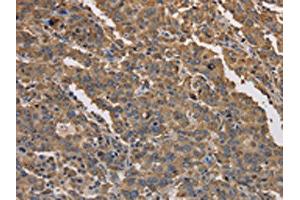 The image on the left is immunohistochemistry of paraffin-embedded Human liver cancer tissue using ABIN7191171(KCNG1 Antibody) at dilution 1/40, on the right is treated with synthetic peptide.
