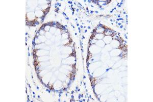 Immunohistochemistry of paraffin-embedded human colon carcinoma using TMED3 antibody (ABIN7270944) at dilution of 1:100 (40x lens). (TMED3 antibody  (AA 24-180))