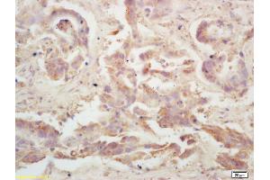 Formalin-fixed and paraffin embedded human colon carcinoma labeled with Rabbit Anti LRP/MVP Polyclonal Antibody, Unconjugated (ABIN671586) at 1:200 followed by conjugation to the secondary antibody and DAB staining