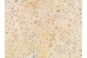 ABIN6265357 and ABIN6278222 at 1/100 staining human hepatocellular carcinoma by IHC-P. (STXBP1 antibody  (C-Term))