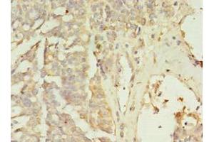 Immunohistochemistry of paraffin-embedded human endometrial cancer using ABIN7176501 at dilution of 1:100 (ZNF699 antibody  (AA 19-195))
