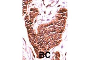 Formalin-fixed and paraffin-embedded human cancer tissue reacted with the primary antibody, which was peroxidase-conjugated to the secondary antibody, followed by DAB staining. (BRSK2 antibody  (C-Term))
