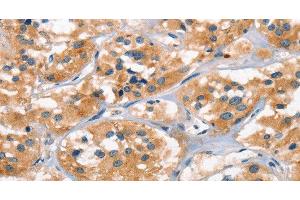 Immunohistochemistry of paraffin-embedded Human thyroid cancer tissue using AHR Polyclonal Antibody at dilution 1:50 (Aryl Hydrocarbon Receptor antibody)