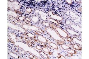 Formalin-fixed and paraffin embedded human kidney carcinoma labeled with Anti-Endostatin Polyclonal Antibody , Unconjugated at 1:200, followed by conjugation to the secondary antibody and DAB staining (COL18A1 antibody  (AA 1581-1680))