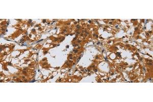 Immunohistochemistry of paraffin-embedded Human thyroid cancer tissue using MIP Polyclonal Antibody at dilution 1:40 (Mip antibody)
