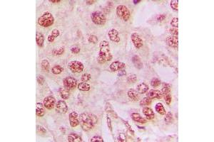 Immunohistochemical analysis of Galectin 3 staining in human lung cancer formalin fixed paraffin embedded tissue section. (Galectin 3 antibody  (Center))