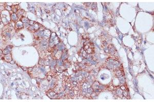 Immunohistochemistry of paraffin-embedded Human colon carcinoma using MRPL23 Polyclonal Antibody at dilution of 1:100 (40x lens). (MRPL23 antibody)