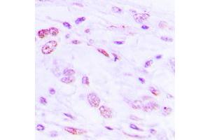 Immunohistochemical analysis of ATF2 (pS112) staining in human lung cancer formalin fixed paraffin embedded tissue section.