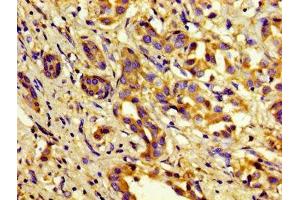 Immunohistochemistry of paraffin-embedded human liver cancer using ABIN7148357 at dilution of 1:100 (C1S antibody  (AA 519-688))