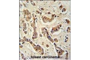 FA20A Antibody (N-term) (ABIN651160 and ABIN2840105) immunohistochemistry analysis in formalin fixed and paraffin embedded human breast carcinoma tissue followed by peroxidase conjugation of the secondary antibody and DAB staining. (FAM20A antibody  (N-Term))