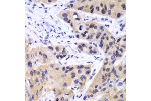 Immunohistochemistry of paraffin-embedded human esophageal cancer using IRF3 antibody. (IRF3 antibody  (AA 1-260))