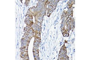 Immunohistochemistry of paraffin-embedded human colon carcinoma using  antibody (ABIN6127437, ABIN6136922, ABIN6136923 and ABIN6217829) at dilution of 1:50 (40x lens). (Annexin A13 antibody  (AA 1-316))