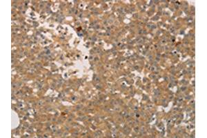 The image on the left is immunohistochemistry of paraffin-embedded Human breast cancer tissue using ABIN7189672(ADCYAP1R1 Antibody) at dilution 1/70, on the right is treated with synthetic peptide. (ADCYAP1R1 antibody)