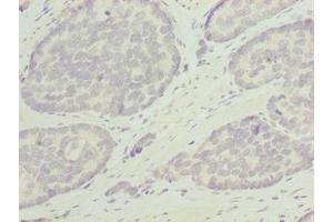 Immunohistochemistry of paraffin-embedded human gastric cancer using ABIN7162346 at dilution of 1:100 (ODF3L1 antibody  (AA 1-274))
