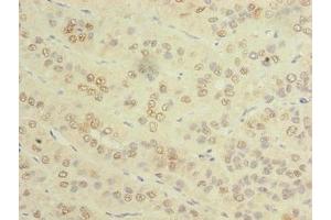 Immunohistochemistry of paraffin-embedded human liver cancer using ABIN7173459 at dilution of 1:100 (TRIM51 antibody  (AA 160-452))