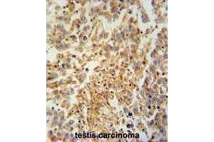 TEX9 antibody (N-term) immunohistochemistry analysis in formalin fixed and paraffin embedded human testis carcinoma followed by peroxidase conjugation of the secondary antibody and DAB staining. (TEX9 antibody  (N-Term))