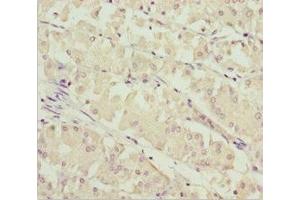 Immunohistochemistry of paraffin-embedded human gastric cancer using ABIN7171004 at dilution of 1:100