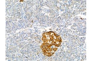 ABIN7093126 and ABIN7098645 at 1/100 staining Human pancreatic cancer and adjacent nomal tissues by IHC-P. (Factor VII antibody  (Internal Region))