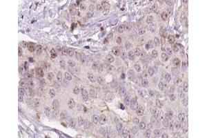 ABIN6266557 at 1/100 staining human liver carcinoma tissue sections by IHC-P. (HCG beta antibody)