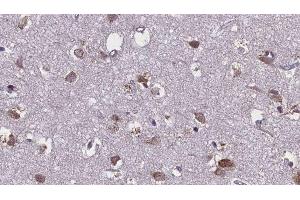 ABIN6276107 at 1/100 staining Human brain cancer tissue by IHC-P. (Mu Opioid Receptor 1 antibody  (C-Term))