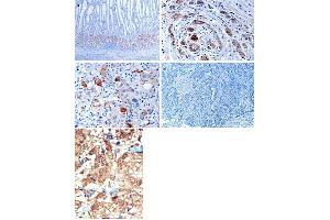 (TOP)Immunohistochemical analysis of EphB1 in gastric cancer tissues.