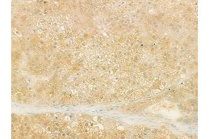 ABIN6259709 and ABIN6273189 at 1/100 staining human hepatocellular carcinoma by IHC-P.
